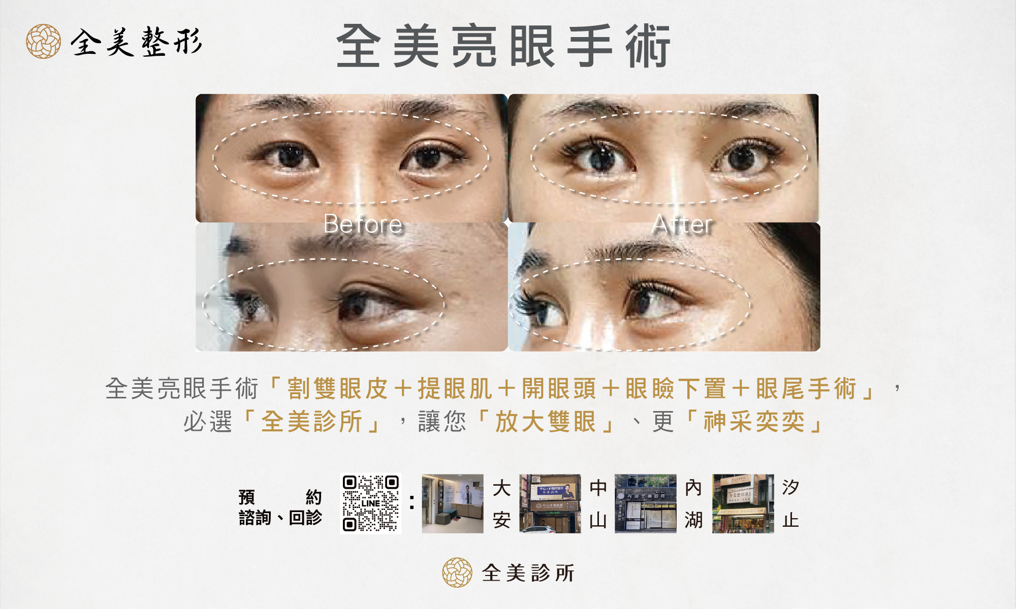 全美亮眼手術-1