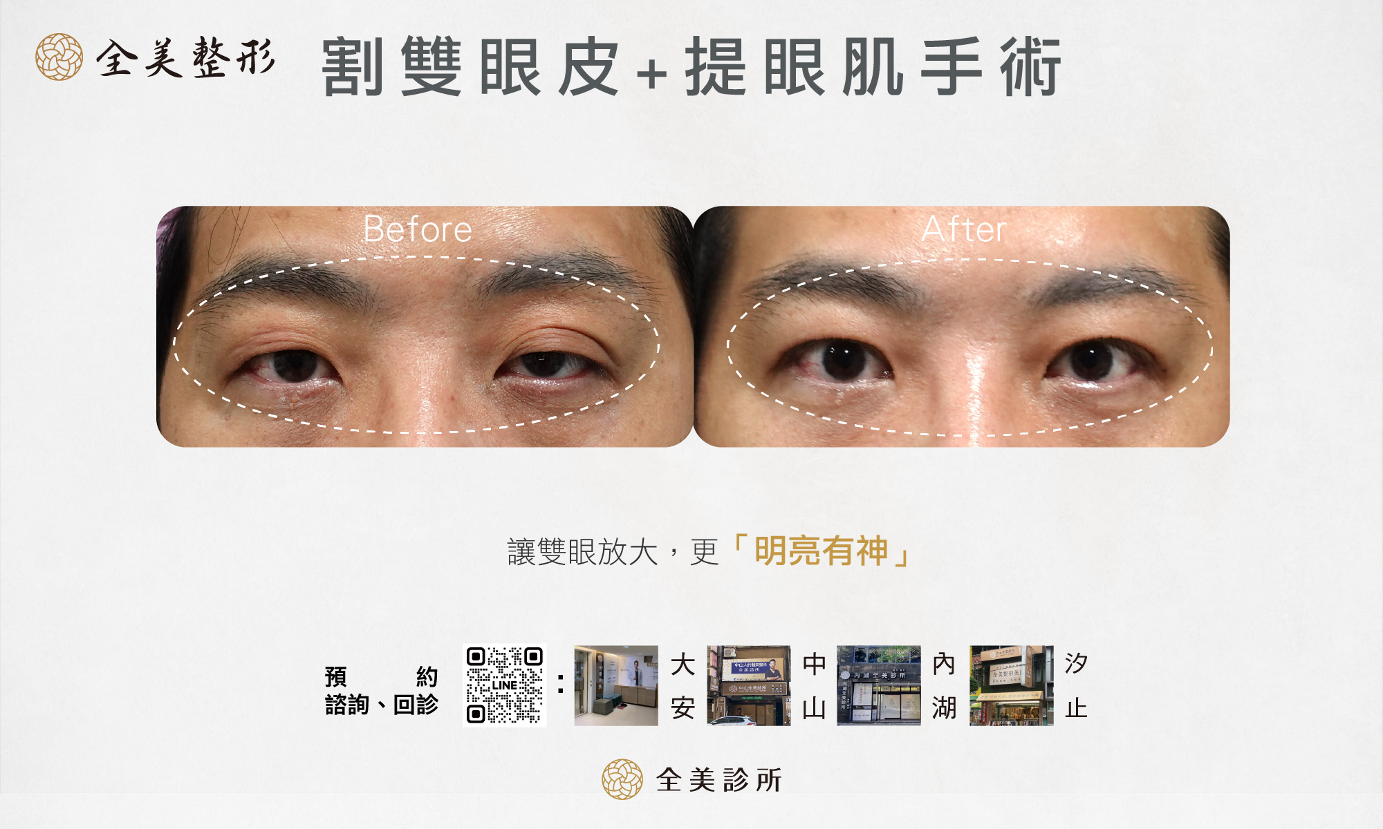 割雙眼皮手術0705