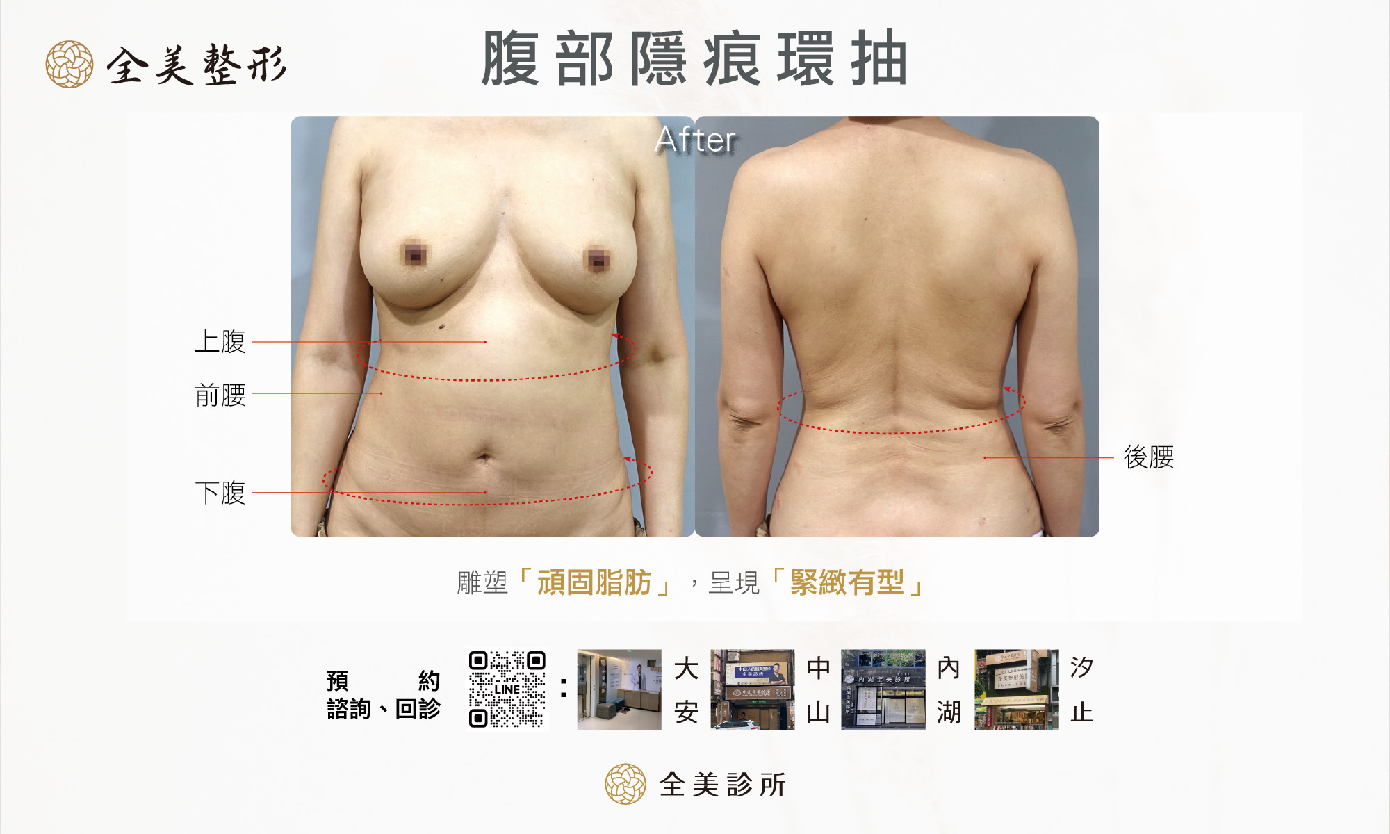腹部隱痕環抽- 全美診所