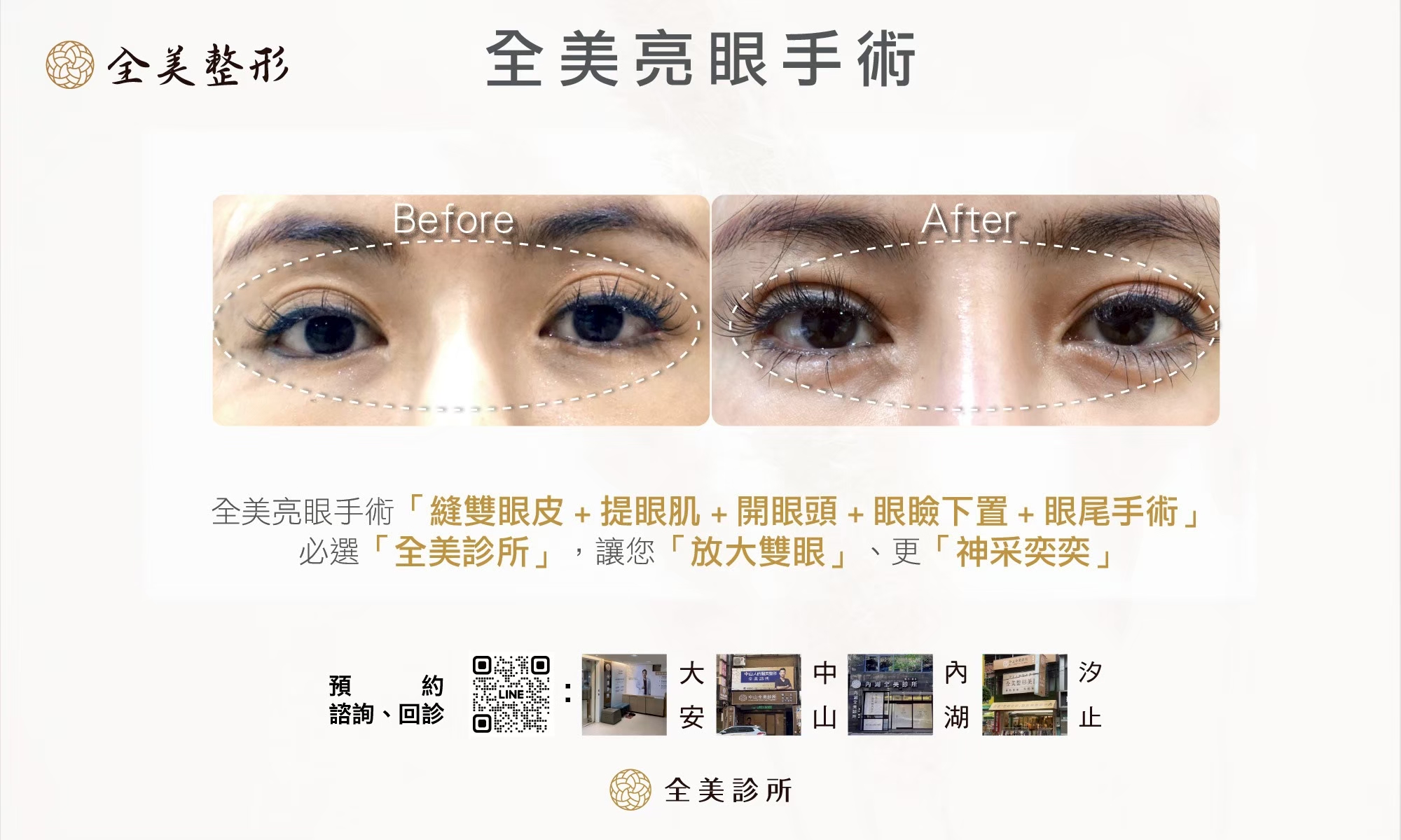 LINE_ALBUM_縫雙眼皮+提眼肌手術_250923_9