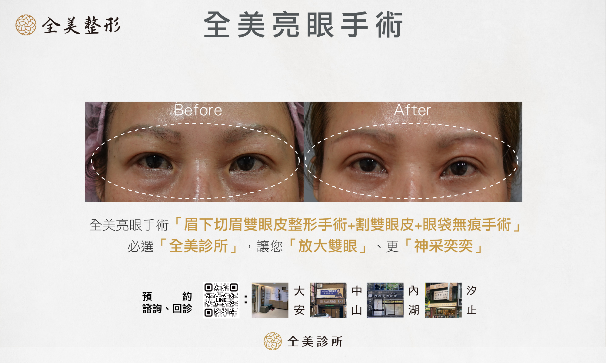 全美亮眼手術-12