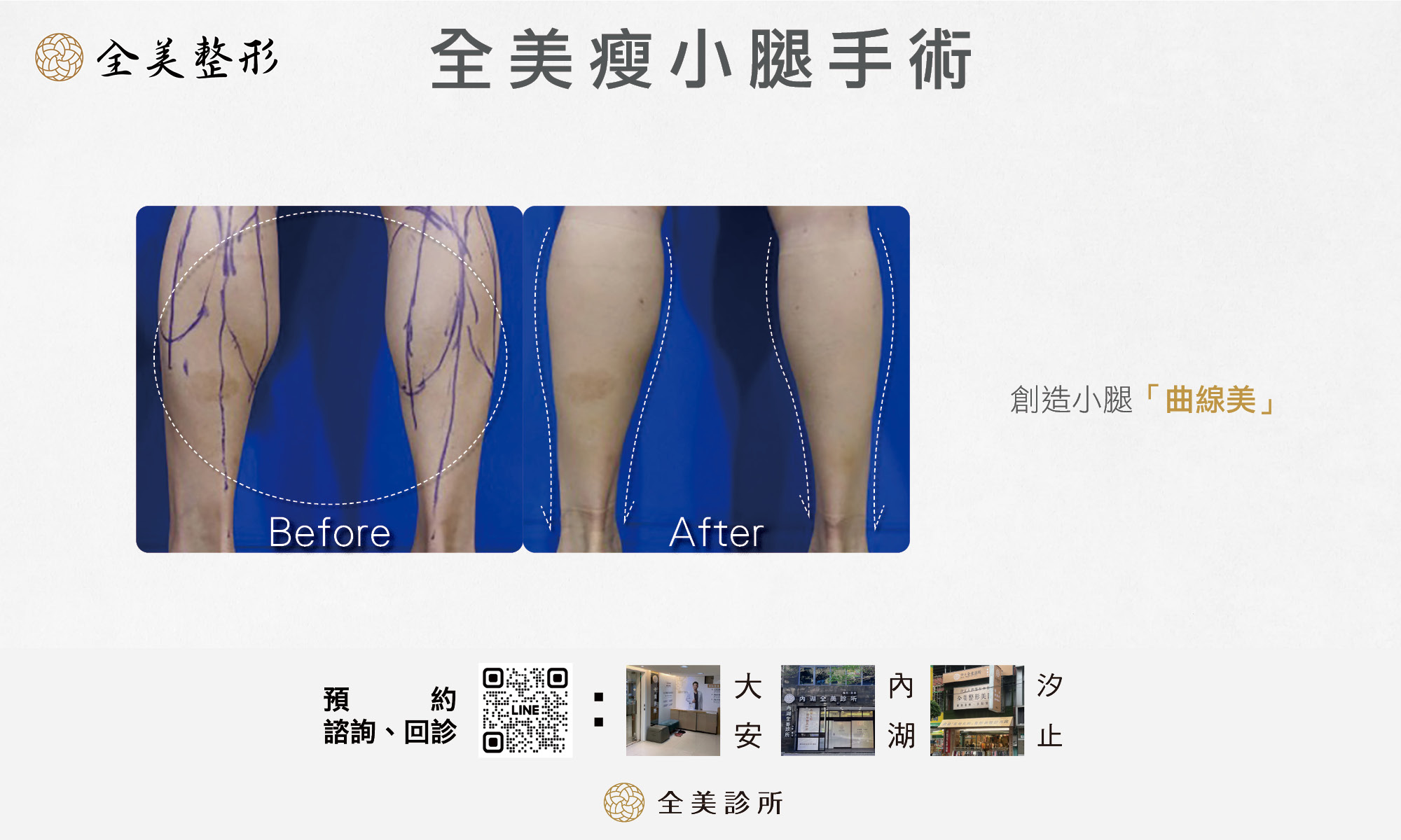全美瘦小腿手術