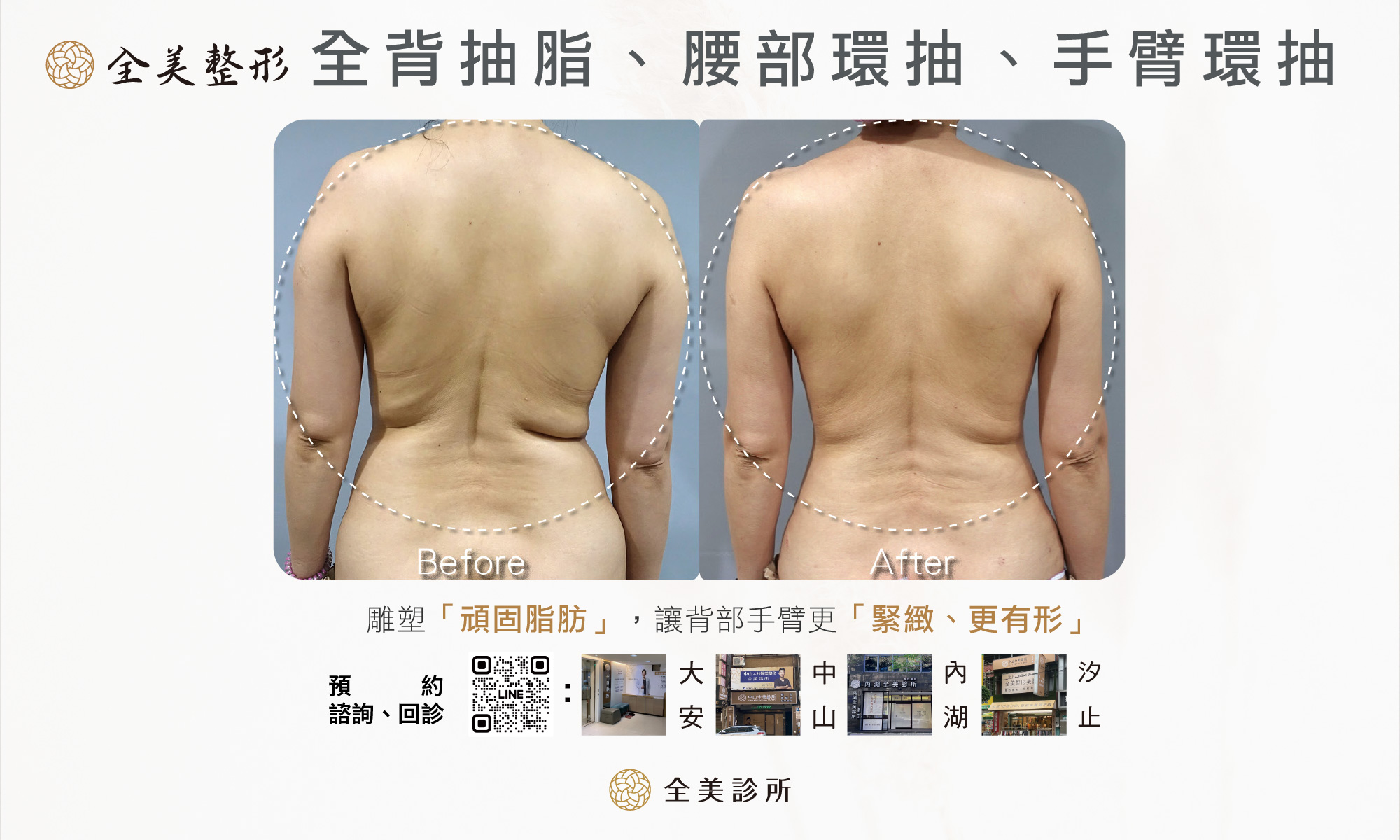 全背抽脂腰部環抽手臂環抽