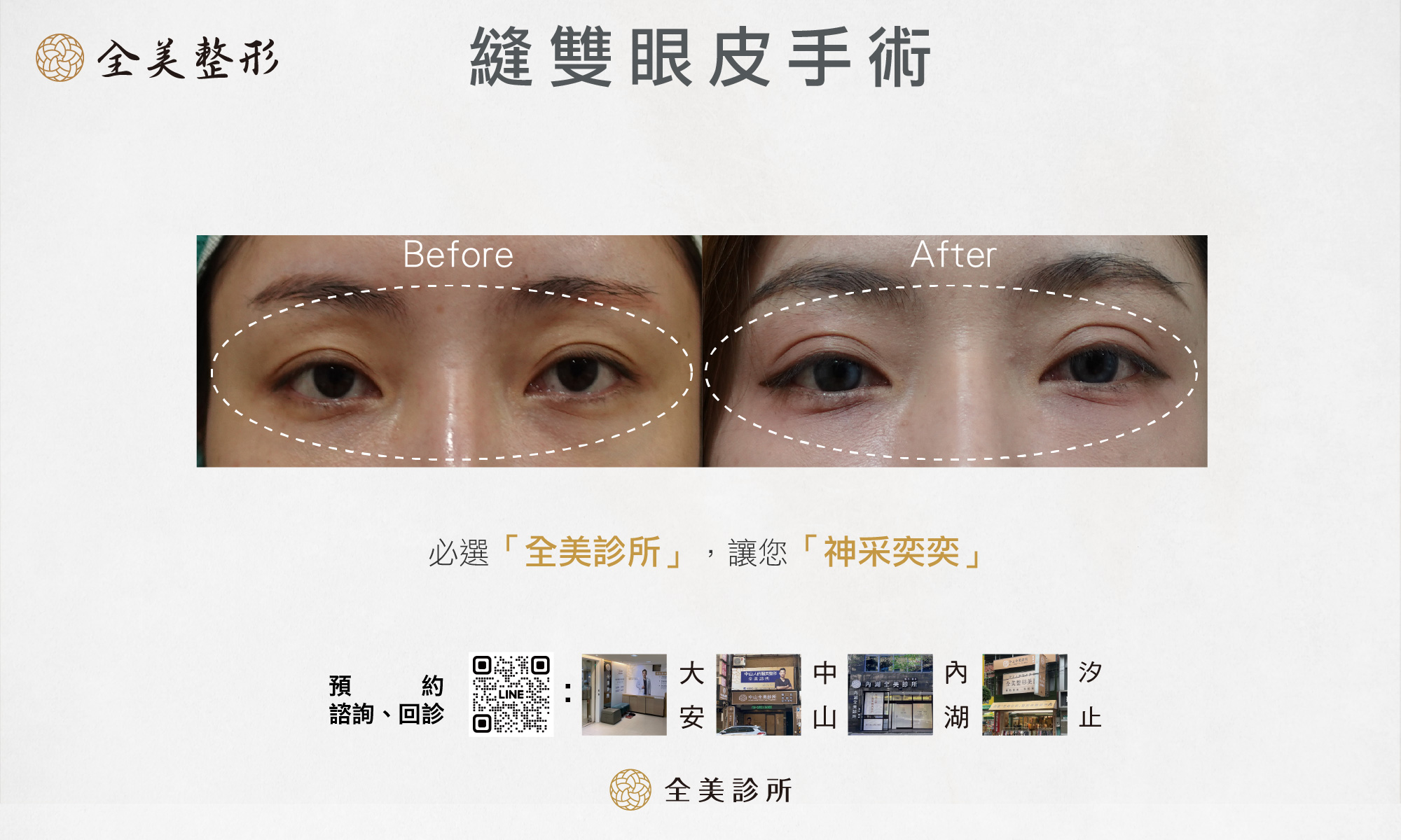 割雙眼皮手術0605-2