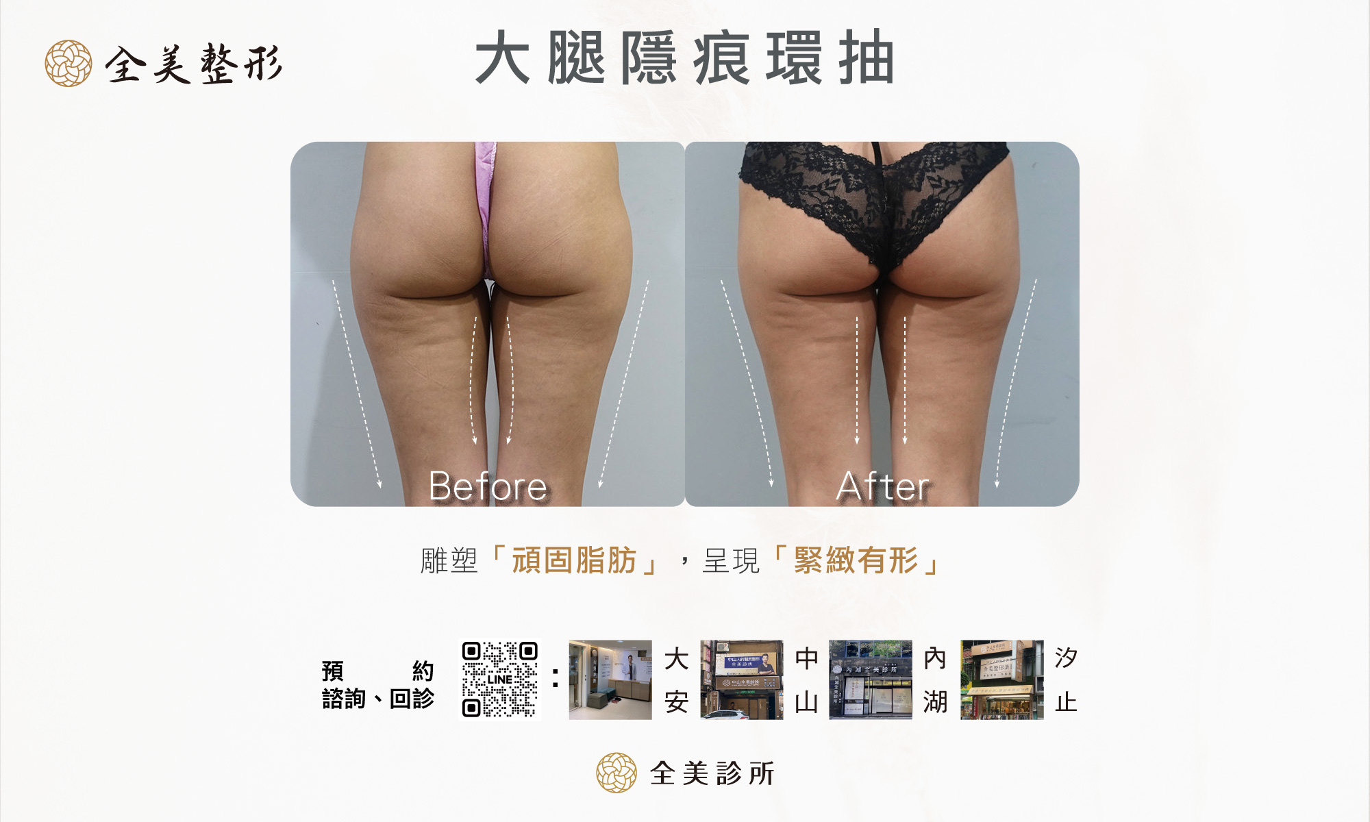 大腿隱痕環抽1