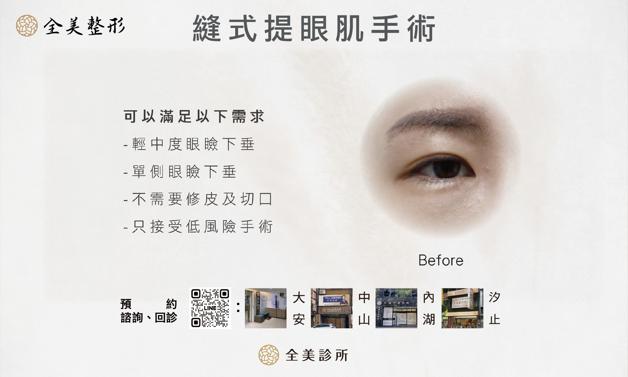 縫式提眼肌手術-3