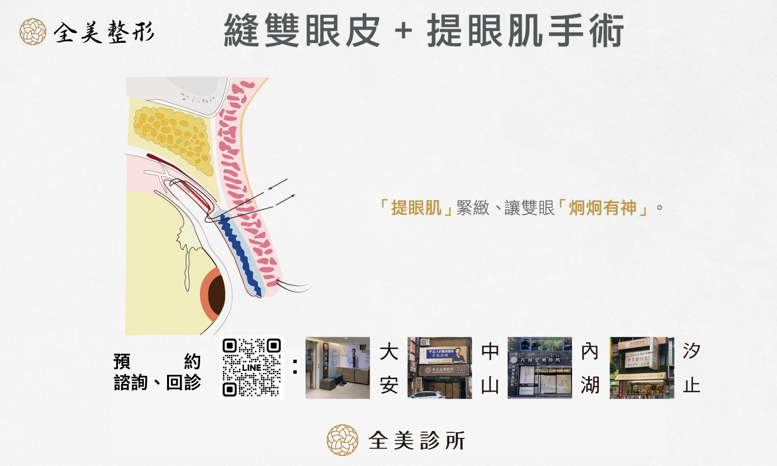 縫雙眼皮+提眼肌手術-2