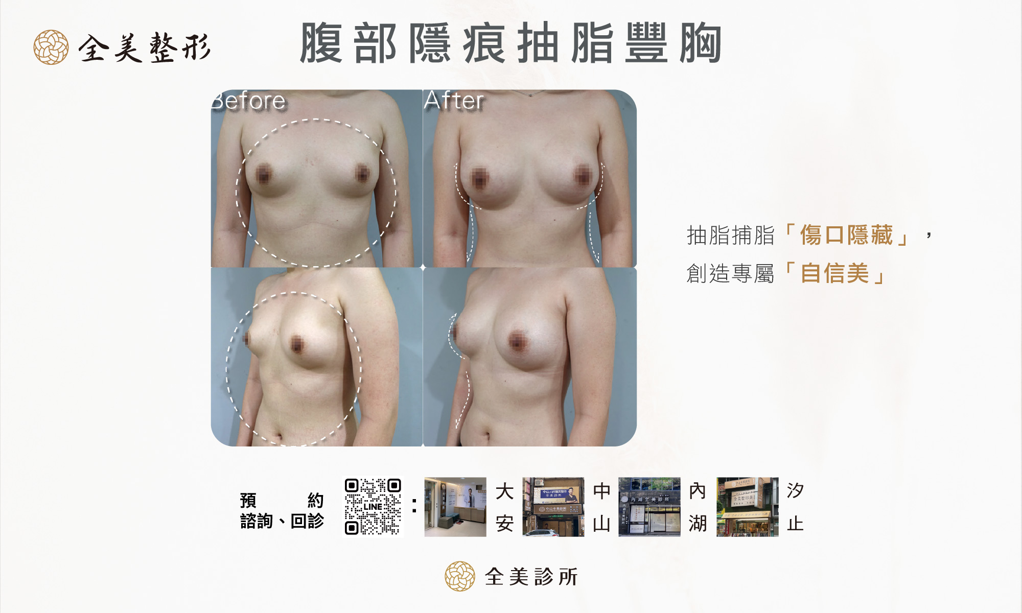 腹部隱痕抽脂封面5