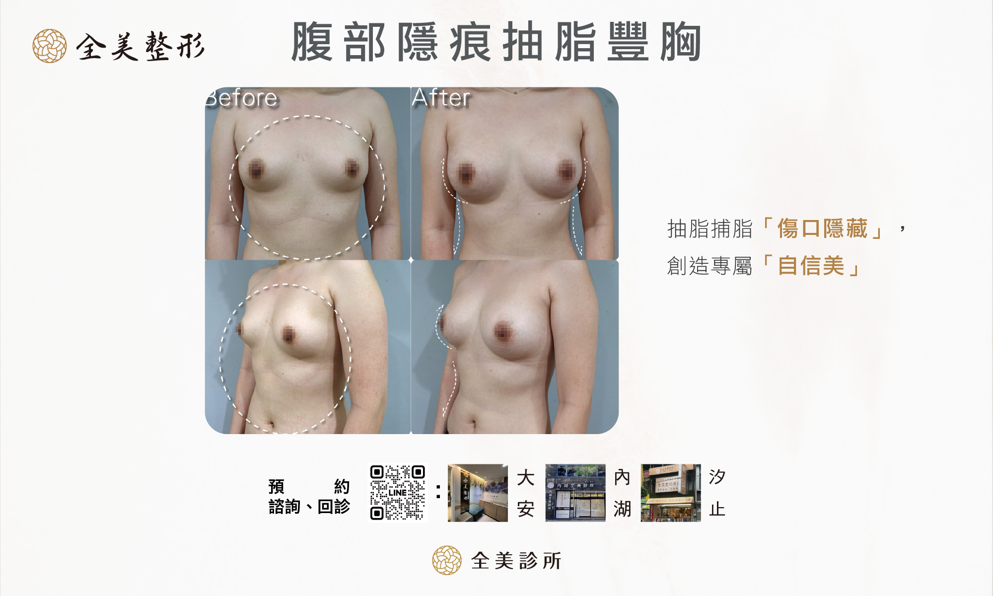 腹部隱痕抽脂封面5