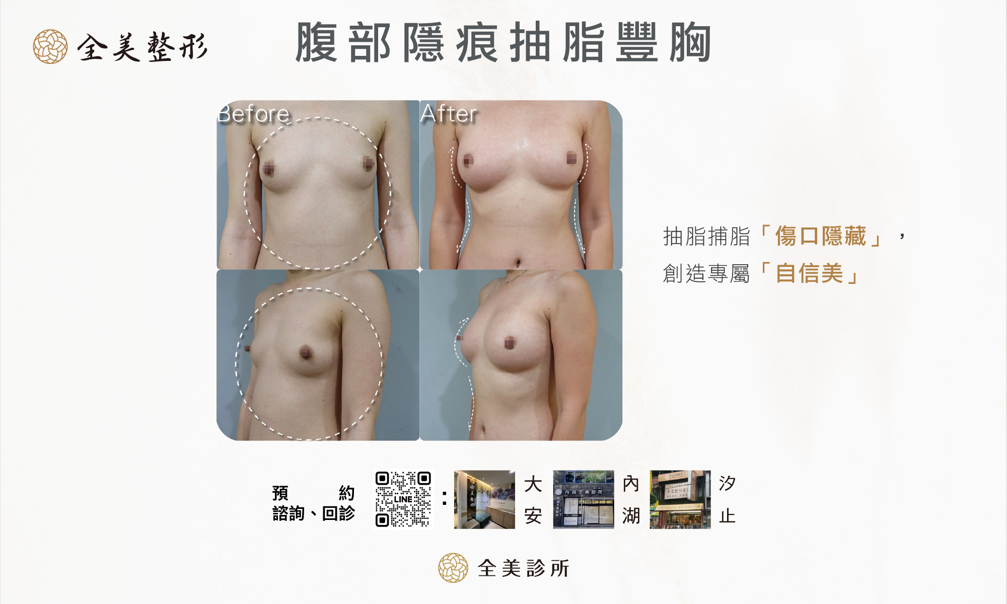腹部隱痕抽脂封面6