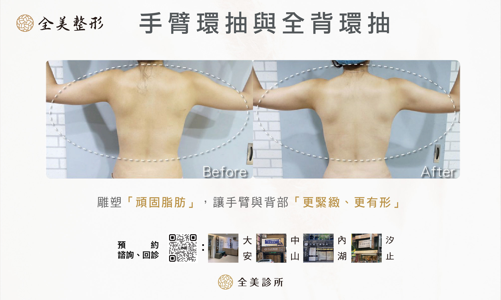 腹部隱痕抽脂封面7