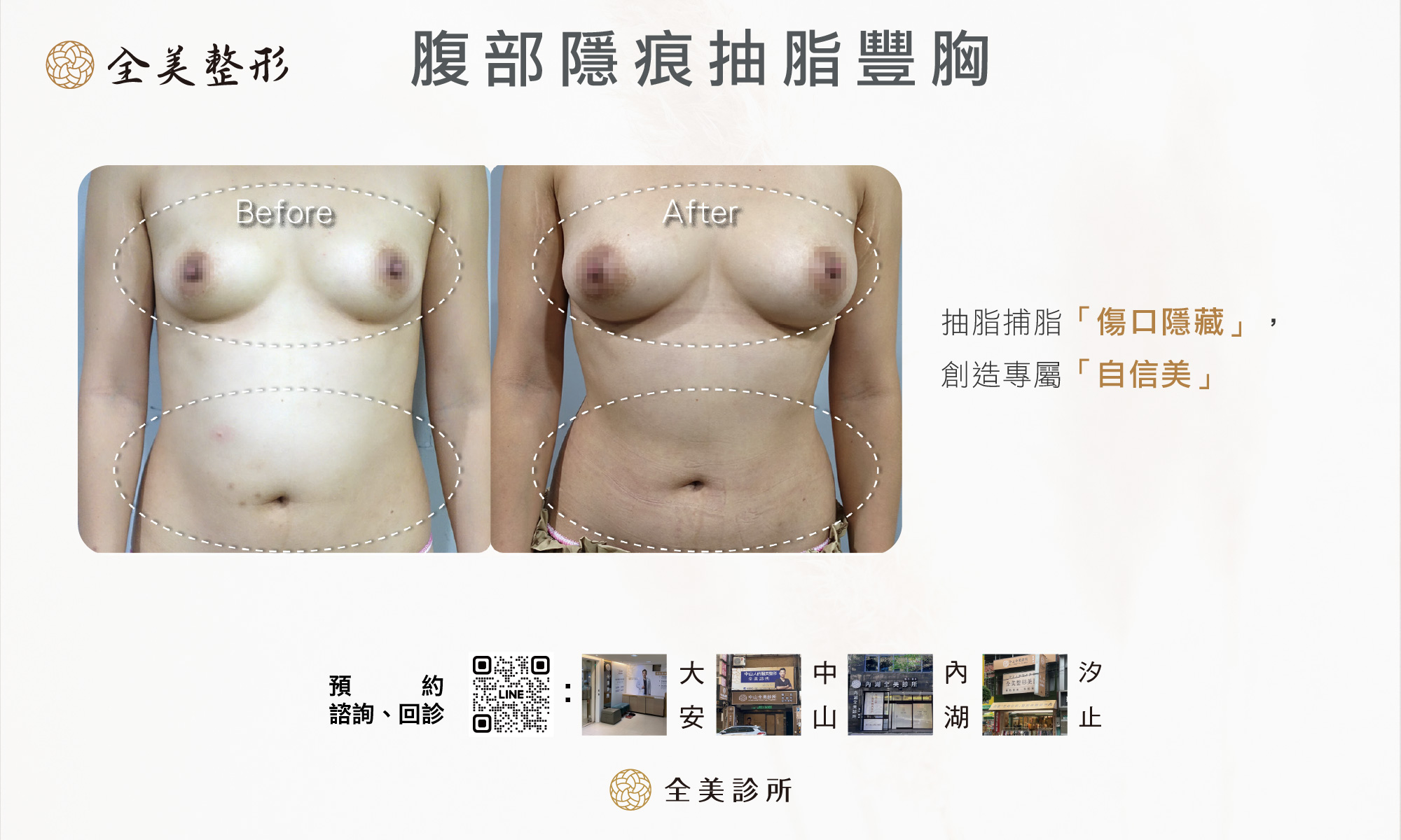 腹部隱痕抽脂豐胸1