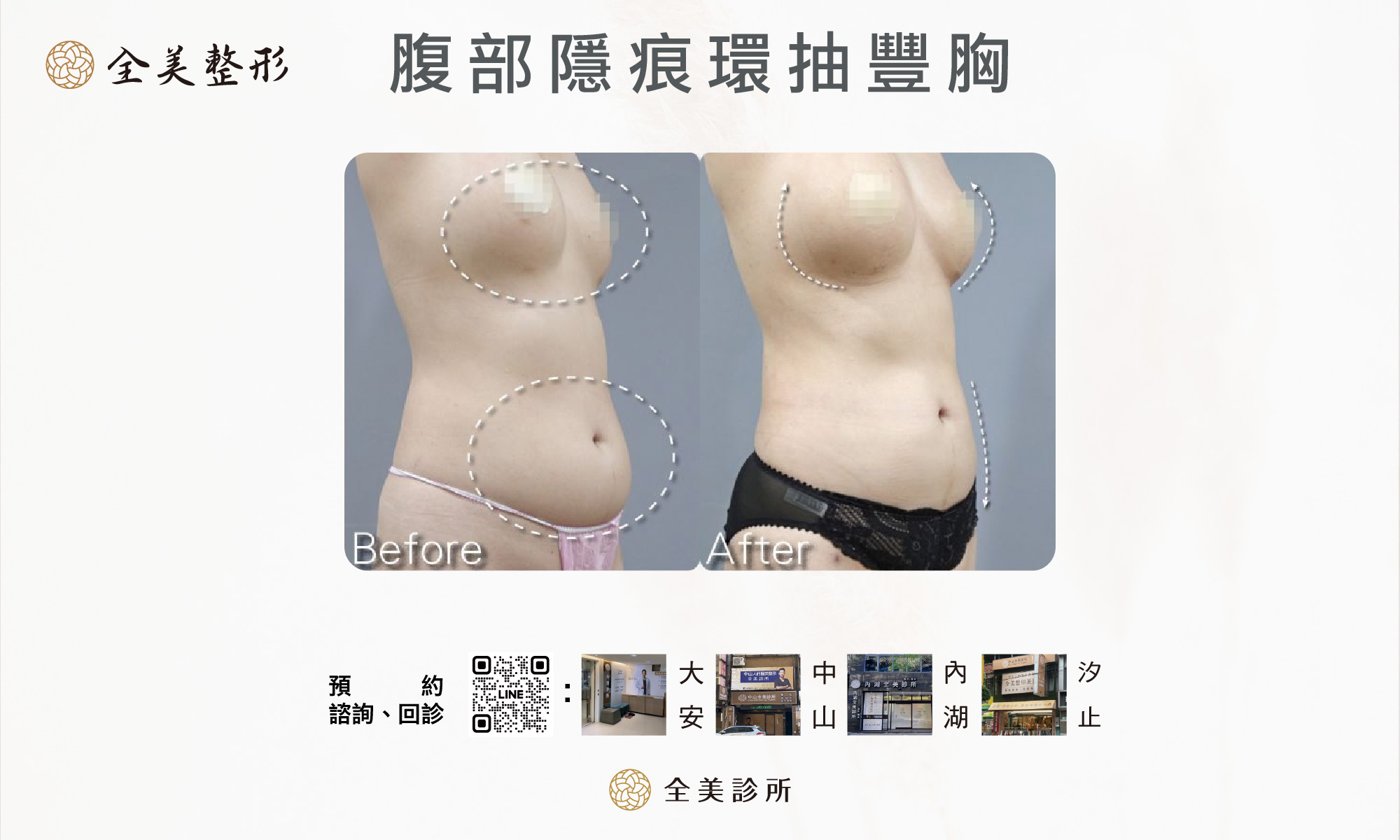 腹部隱痕環抽豐胸