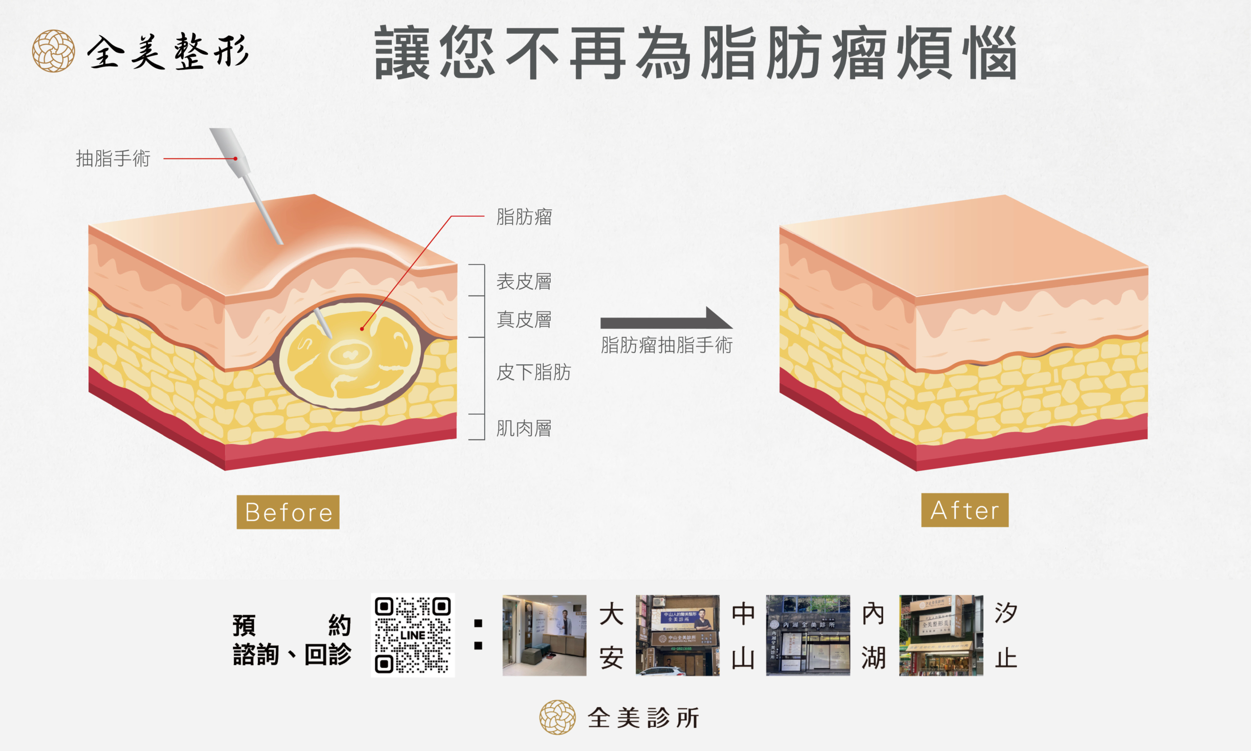 讓您不再為脂肪瘤煩惱