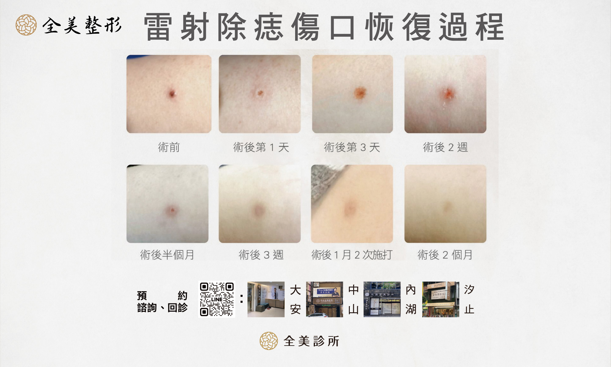 雷射除痣傷口恢復過程