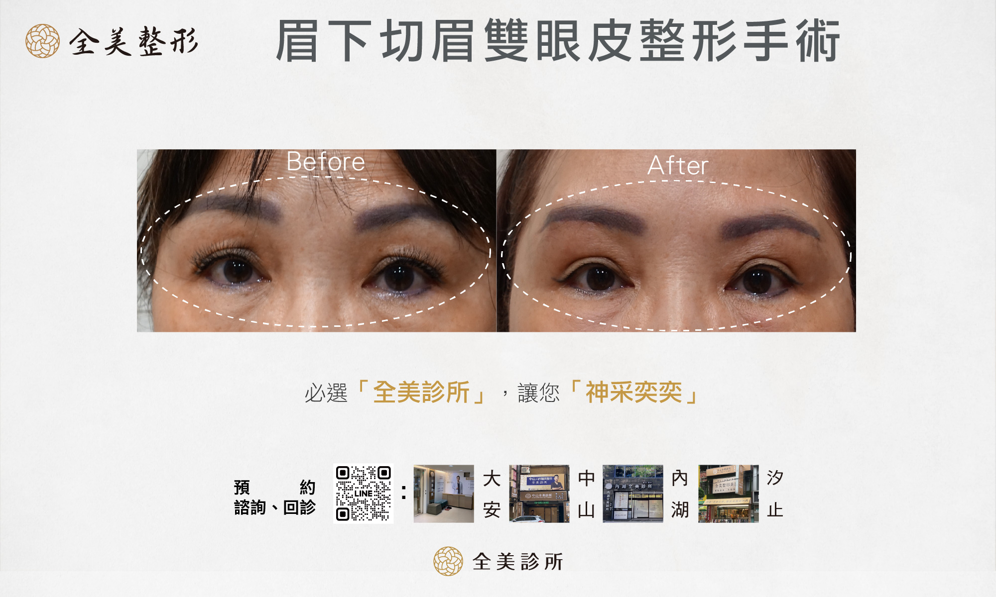 眉下切眉雙眼皮整形手術-1