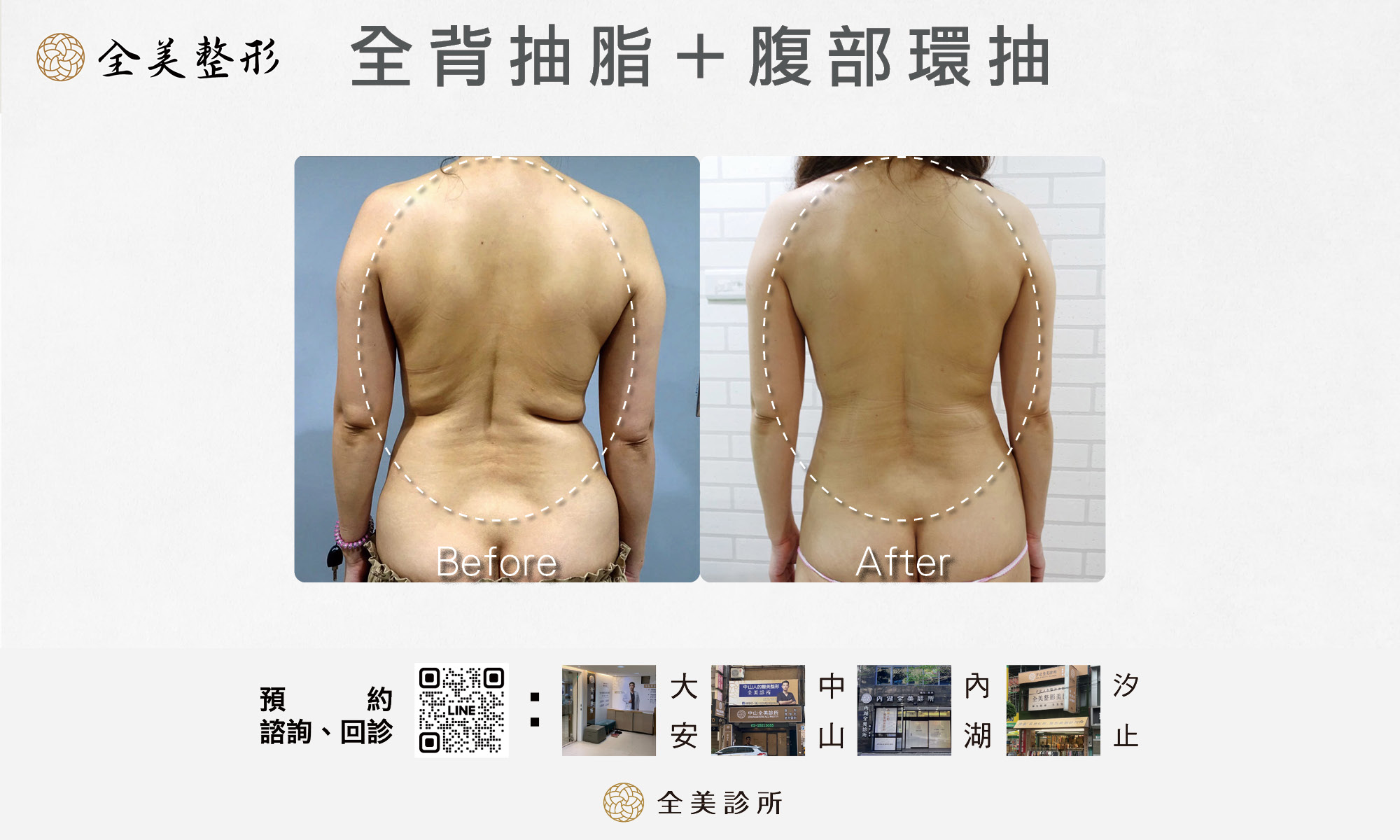 全背抽脂+腹部環抽