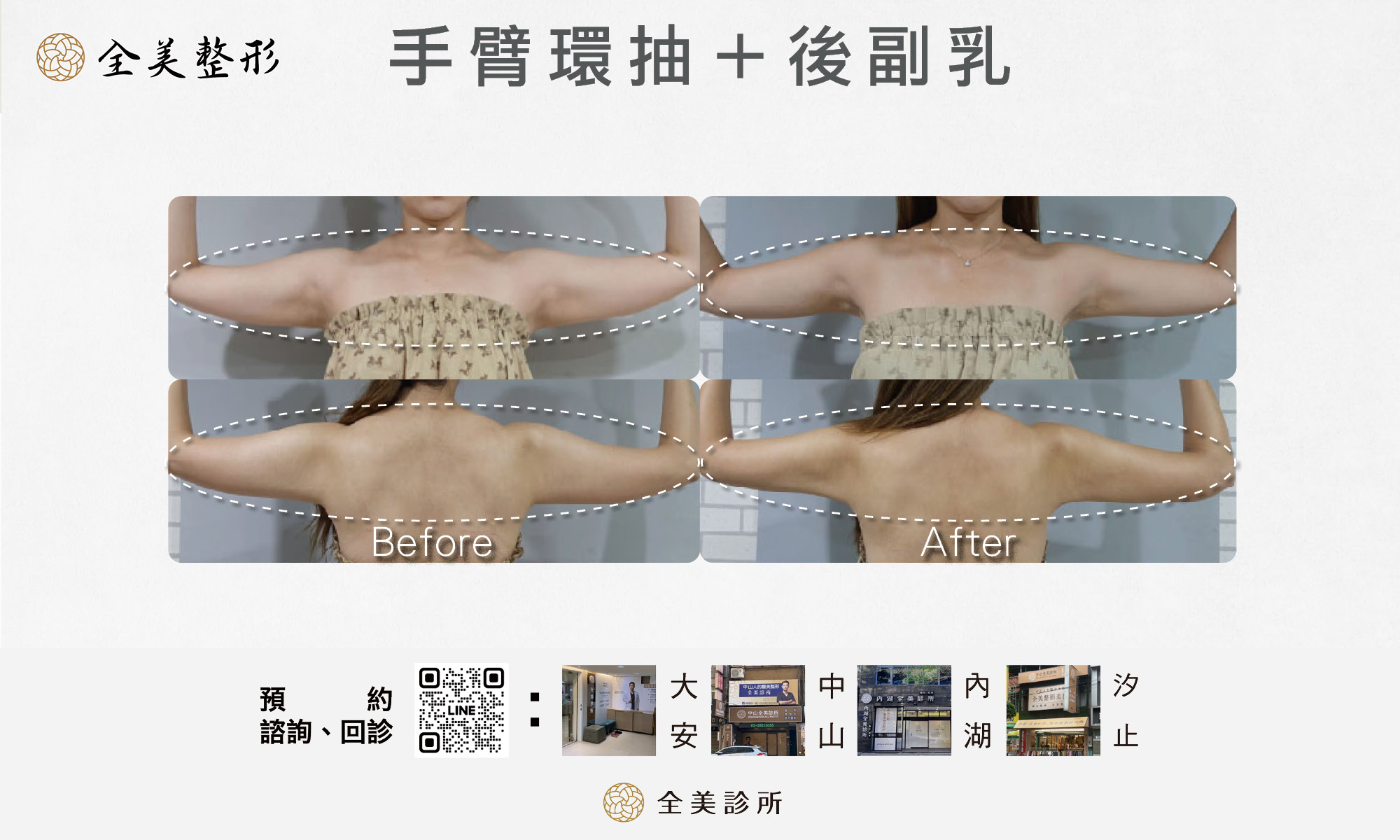 手臂環抽+後副乳