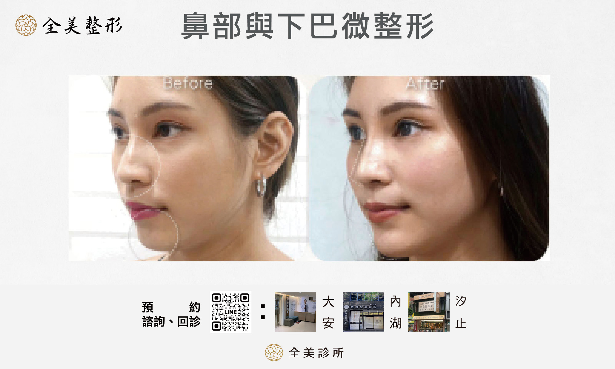 鼻部與下巴微整形